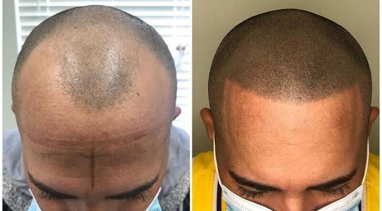 What Can Scalp Micropigmentation Be Used For?